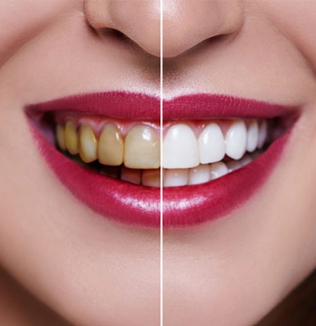 teeh-whitening teeh-whitening